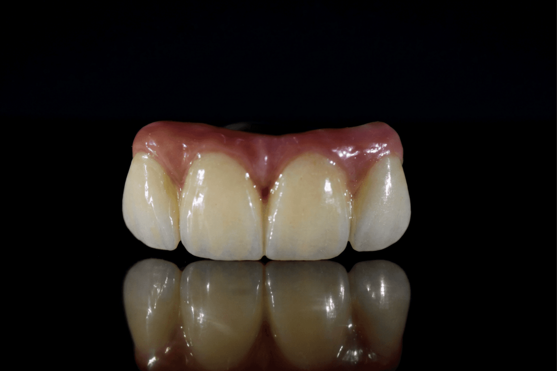 Alternativas protésicas dentales con alta estética - DigiDent