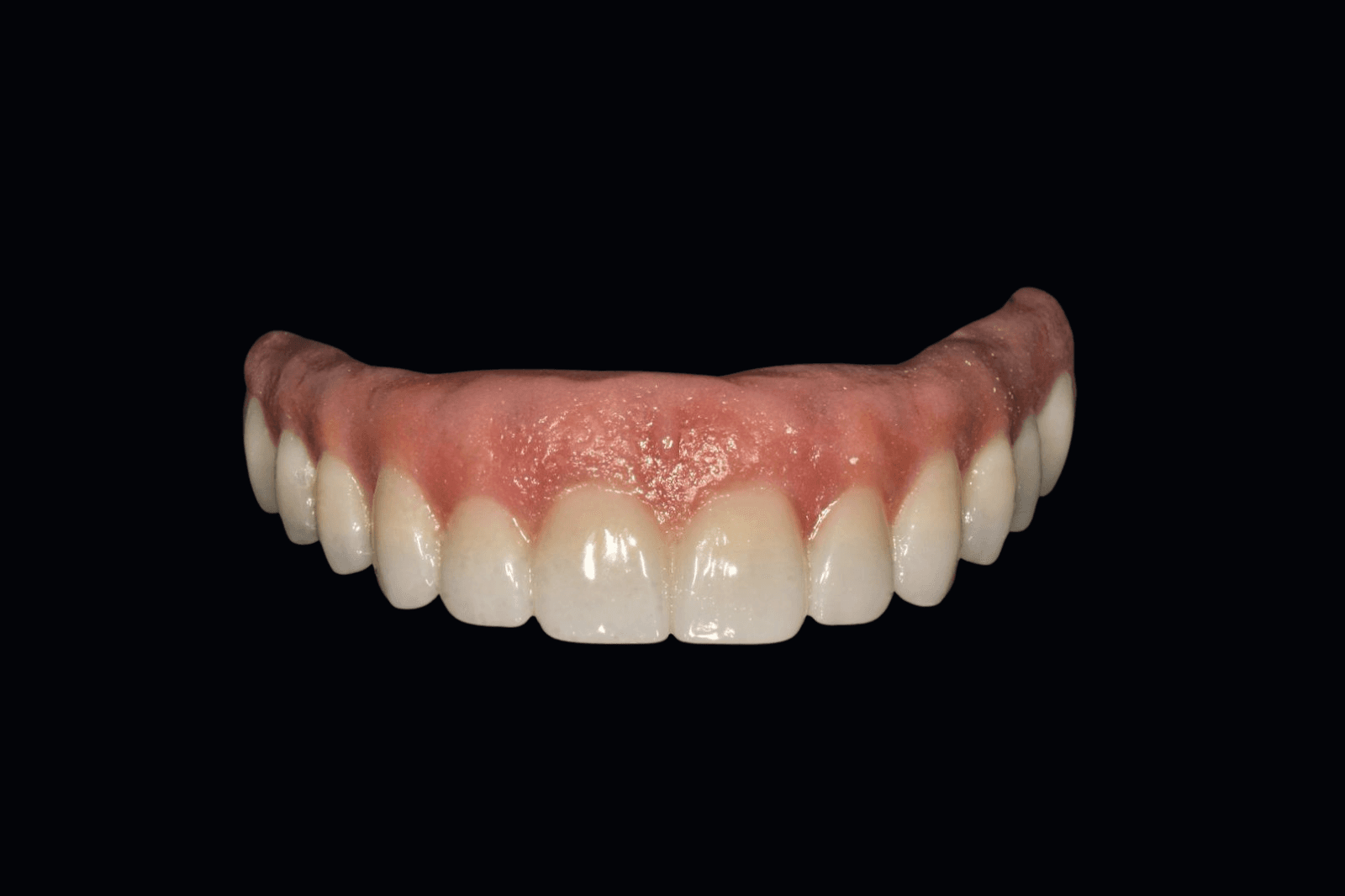 Prótesis Full Arch sobre implante de zirconia monolítica - DigiDent