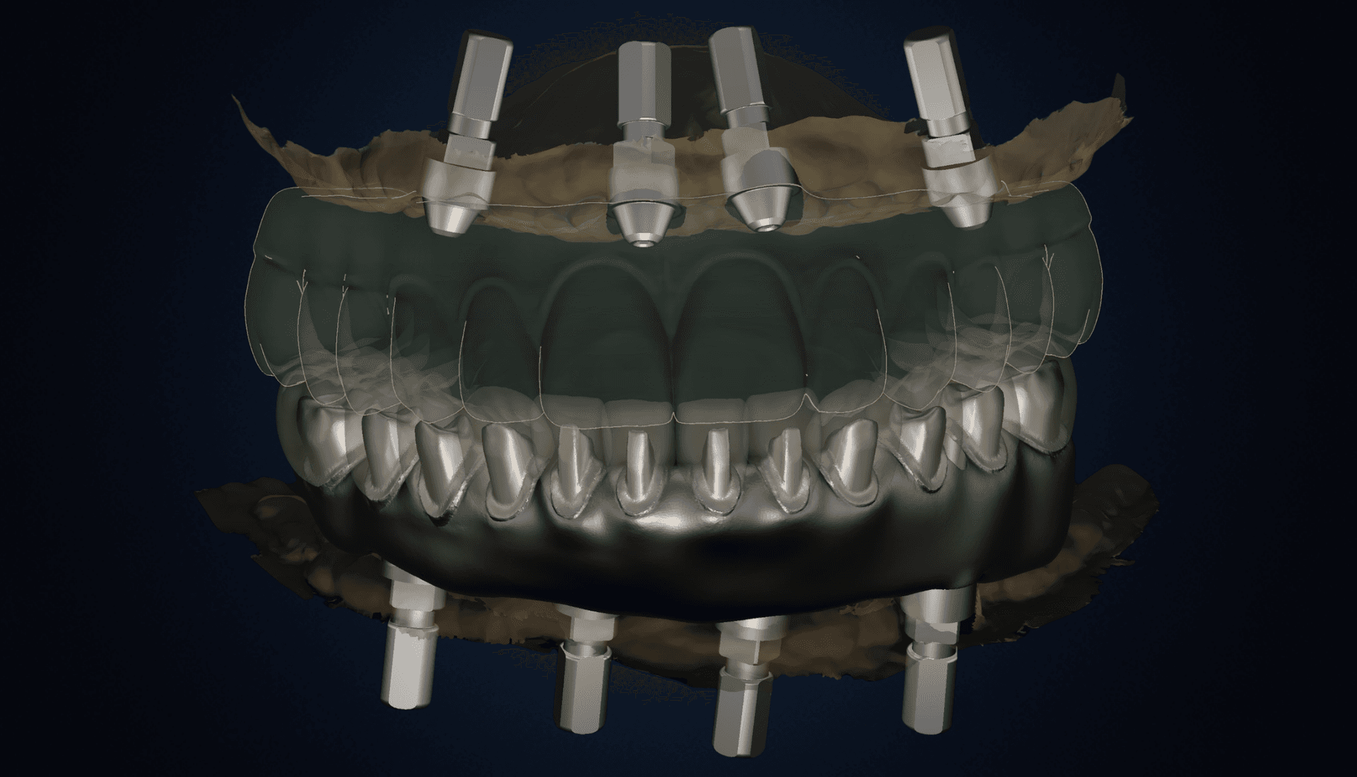 Implantes dentales digitales renderizados en 3D - DigiDent laboratorio dental Monterrey